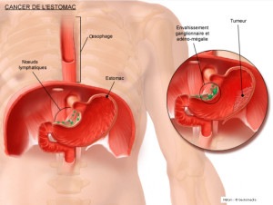 chirurgie-digestive-cancer-estomac